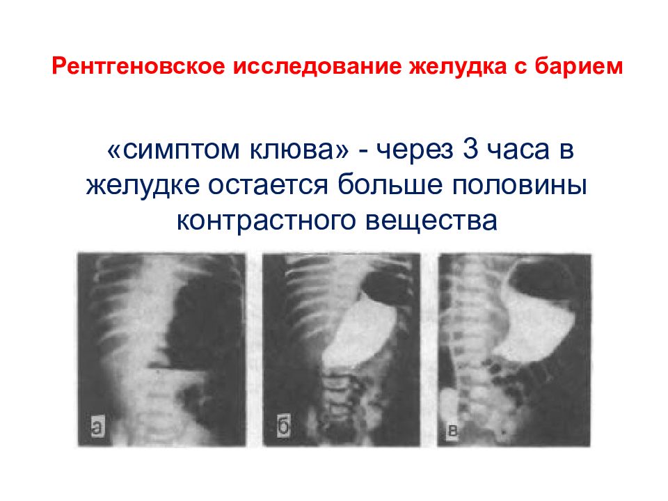 При пилоростенозе стул какой