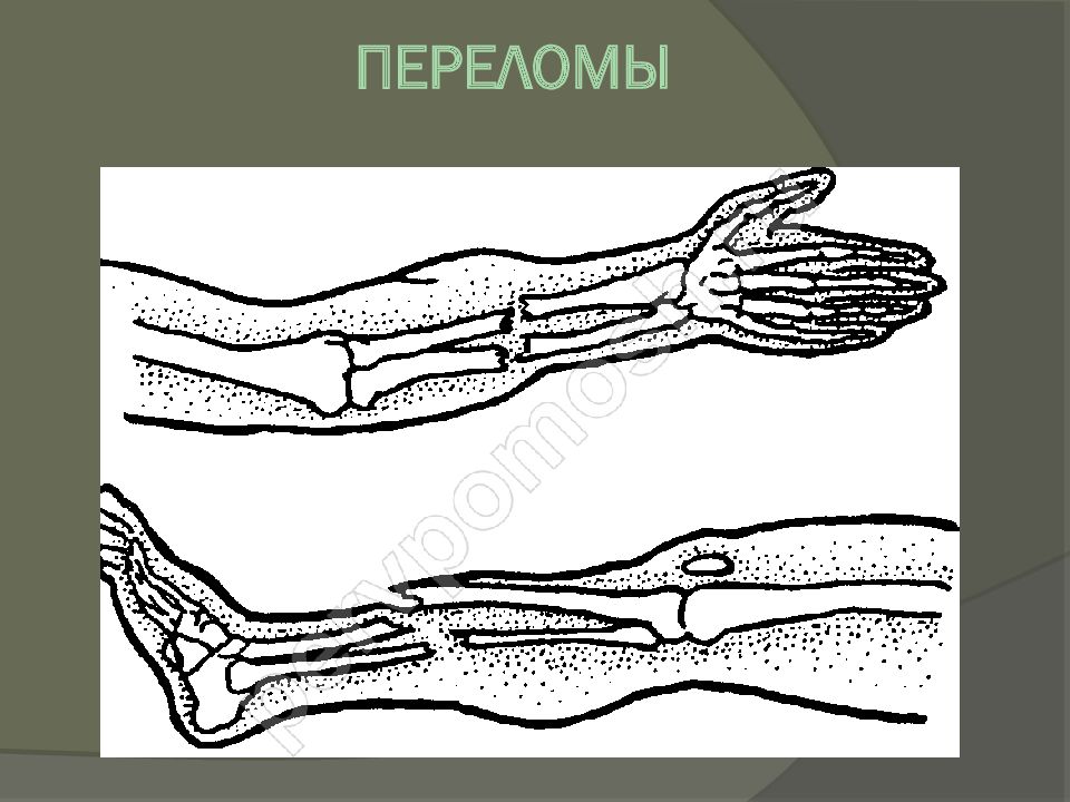 Перелом это. Переломы костей закрытый открытый. Открытый и закрытый перелом кости. Переломы верхних конечностей открытый и закрытый. Переломы по целостности кожных покровов.