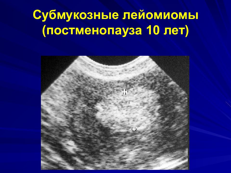 Субмукозная матка. Субмукозная миома матки УЗИ. Субмукозная лейомиома. Субмукозный узел в матке дифференциальная диагностика.