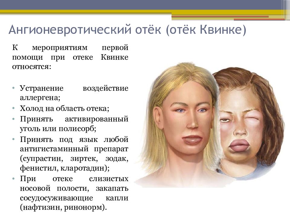 Ангионевротический отек карта вызова скорой медицинской