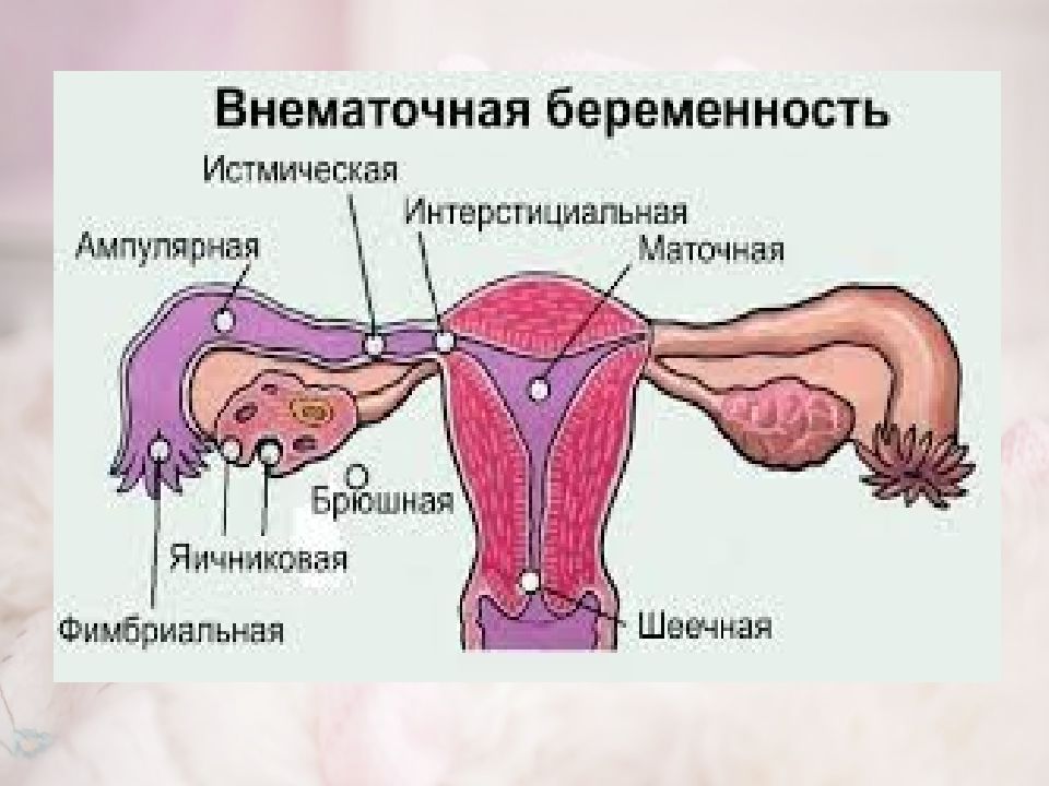 Внематочная беременность картинки для презентации