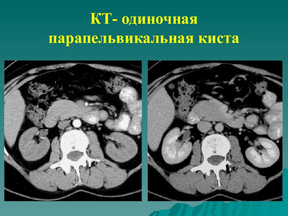 Парапельвикальные кисты почек