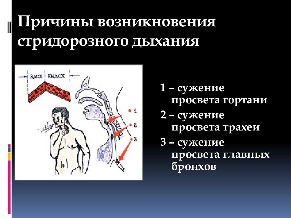 Не дают трахее сужаться. Стридорозное дыхание. Причины стридорозного дыхания. Стридорозное дыхание характерно для. Причины стридорозного дыхания у взрослых.