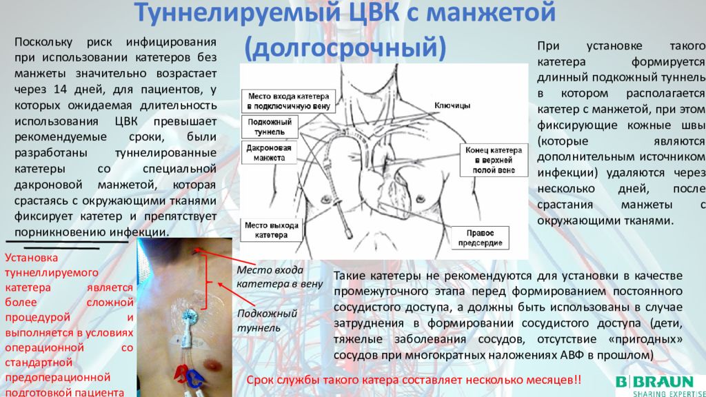 Центральная вена. Центральный венозный катетер. ЦВК Центральный венозный катетер. Установка центрального венозного катетера. Центральный венозный катетер строение.