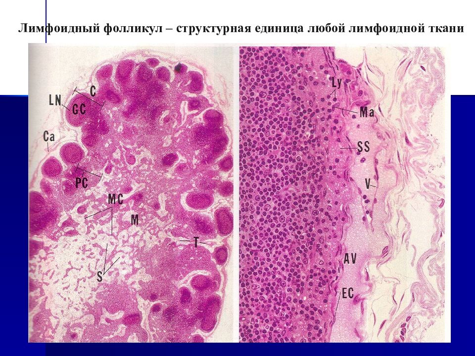Лимфоидная опухоль. Лимфоидная ткань гистология. Лимфоидный фолликул гистология. Лимфоидная ткань кишечника.