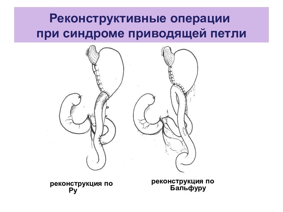 Резекция желудка по бальфуру схема