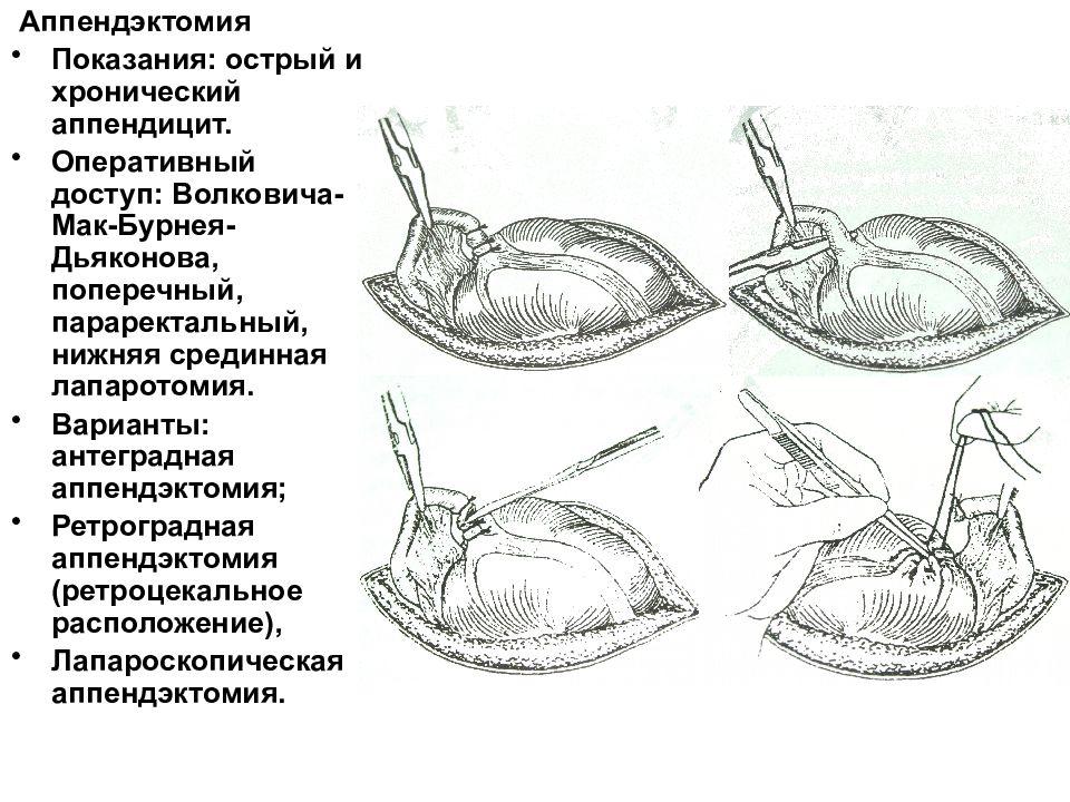 При типичной картине острого аппендицита операционным доступом является