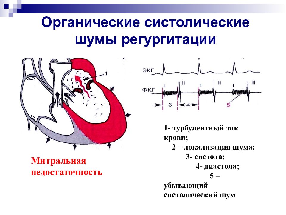 Аускультативная картина митральной недостаточности. Митральная недостаточность аускультативная картина. Шумы сердца схема. Особенностью аускультативной картины сердца у детей является. Органические шумы сердца.