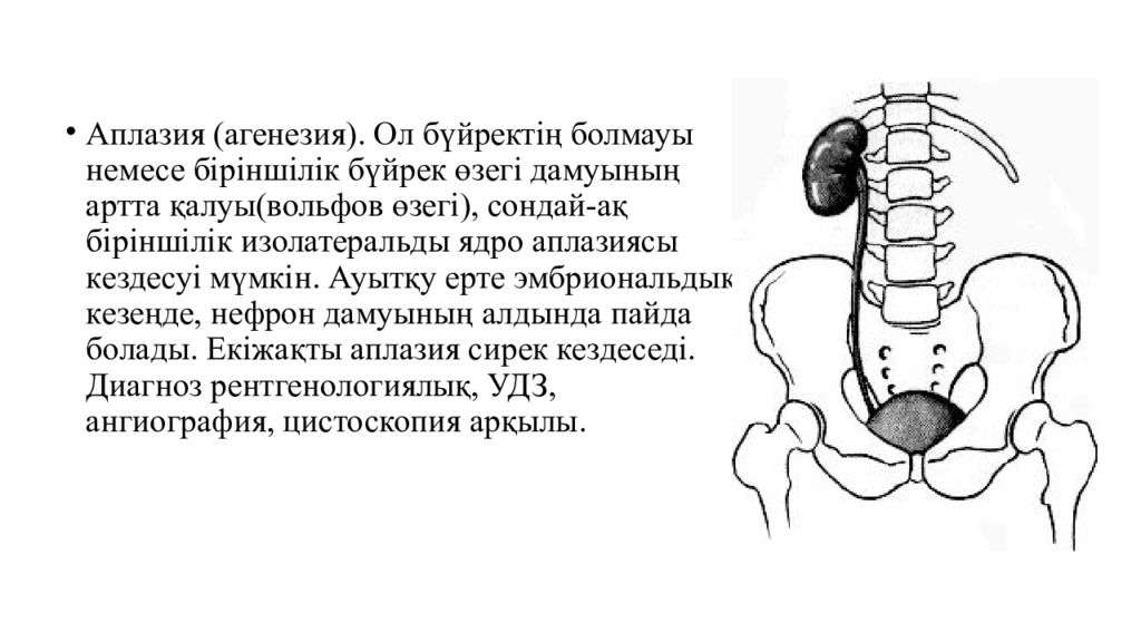 Агенезия это. Агенезия и аплазия почки. Односторонняя аплазия (агенезия) почки.