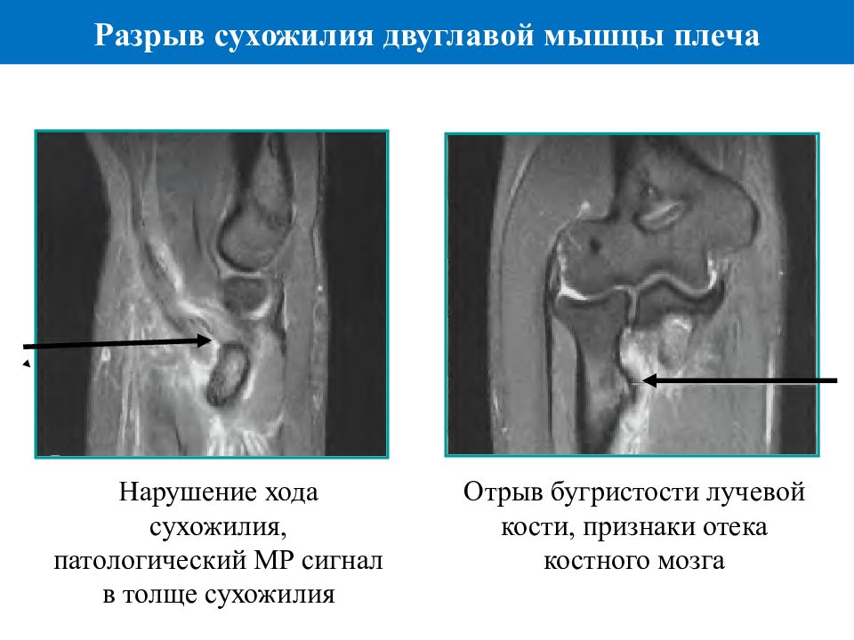 Диагностика повреждения сухожилий. МР сигнал это патологический что значит.