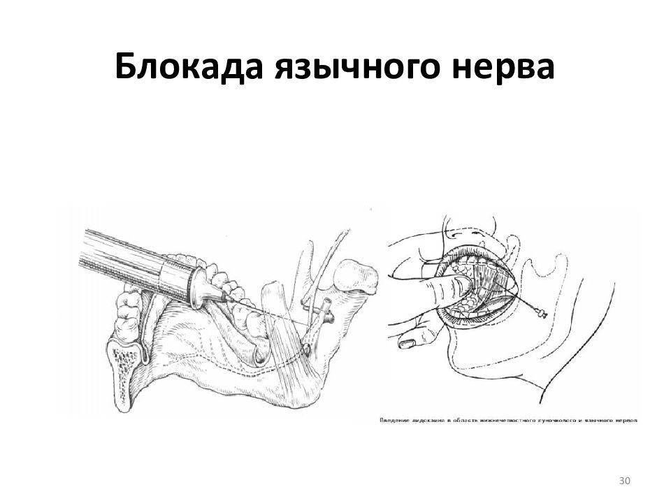 Блокада нерва. Методика анестезии язычного нерва. Методика блокирования язычного нерва.. Тримекаиновые блокады язычного нерва.