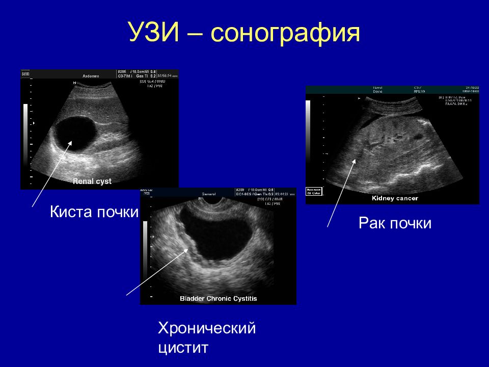 Сонография это. Ультразвуковые исследования(сонография ) почек. УЗИ почек сонограмма. Сонограмма опухоль почки. Ультразвуковая диагностика (сонография, УЗИ).