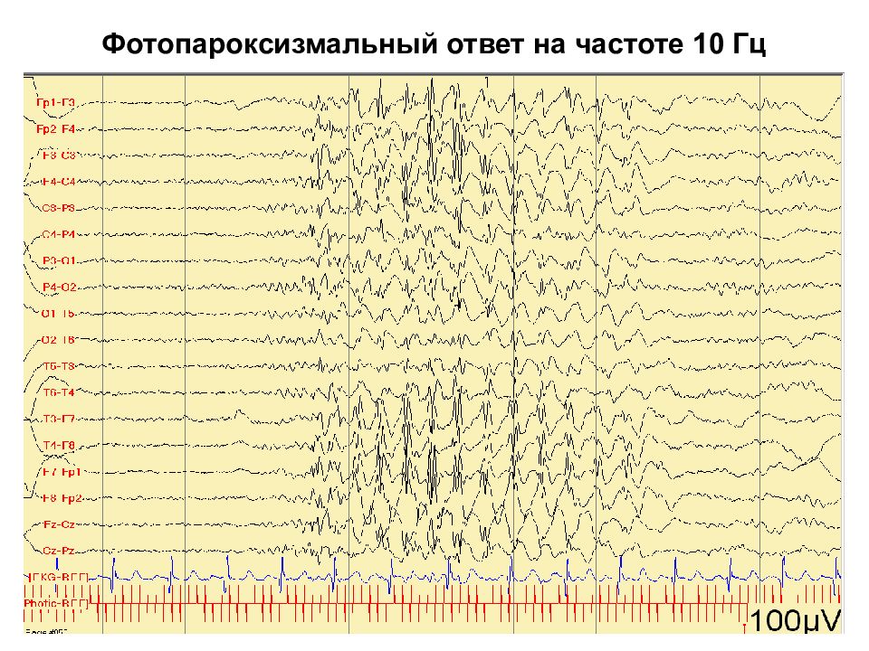 Ээг эпилепсия картинки