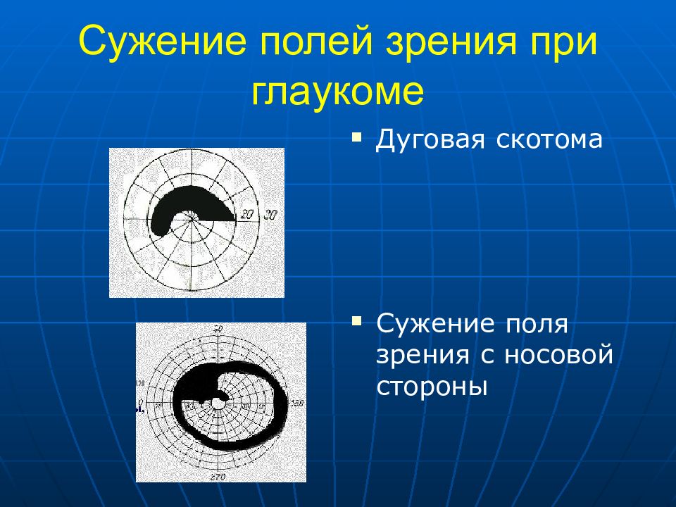 Полем зрения называется. Скотома Бьеррума. Концентрическое сужение полей зрения. Локальное сужение полей зрения. Сужение периферического поля зрения.