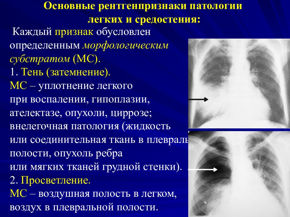 Ли затемнение легких. Синдром уплотнения легочной ткани рентген. Синдром уплотнения легкого рентген. Синдром легочного уплотнения рентген. Уплотнение легочной ткани на рентгене.