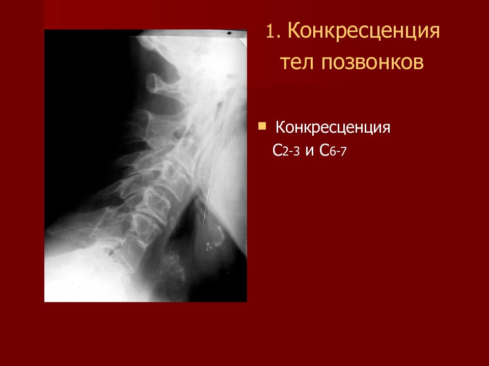 Конкресценция позвонков. Конкресценция с1 с2 рентген. Синостоз шейных позвонков с2-с3. Конкресценция с3 с4. Аномалия развития конкресценция позвонков с2-с3.