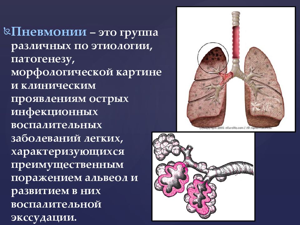 Пневмония легких осложнения. Стрептококковая пневмония. Экссудация при пневмонии. Дифтеоетическпя воспаление лёгких.