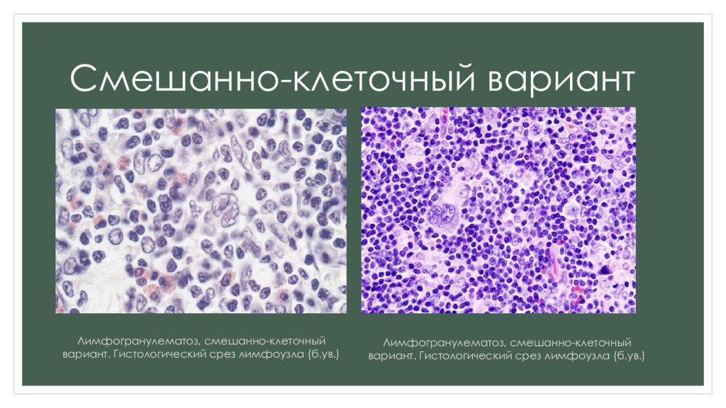 Варианты клеток. Смешанно клеточный вариант лимфомы Ходжкина микропрепарат. Смешанноклеточный вариант лимфомы Ходжкина. Диагностические клетки лимфомы Ходжкина. Смешанно-клеточный вариант болезни Ходжкина.