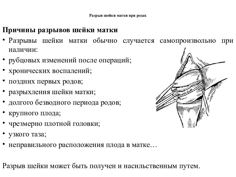 Разрыв промежности при родах фото