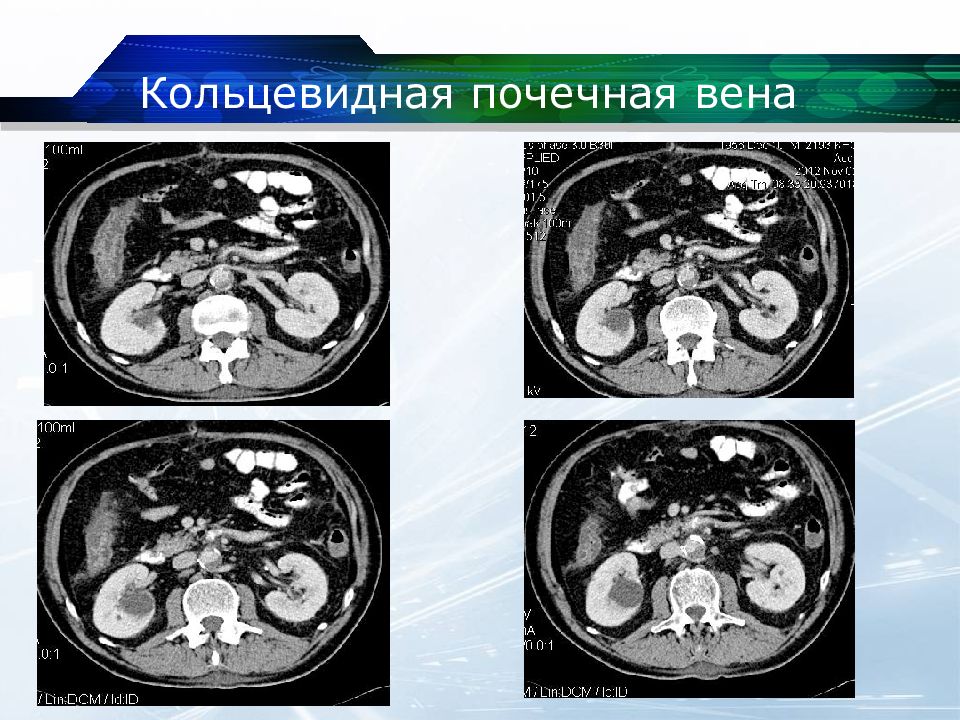 Почечная вена. Ретроаортальная левая почечная Вена кт. Ретроаортальная почечная Вена. Левая почечная Вена кт. Кольцевидная почечная Вена.