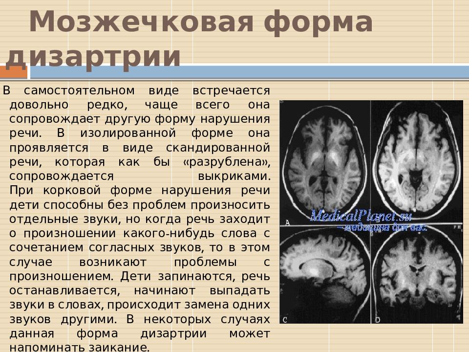 Мозжечковая дизартрия презентация