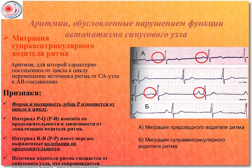 Умения приведенные до автоматизма называют. Нарушение функции АВТОМАТИЗМА синусового узла. Аритмии обусловленные нарушением функции АВТОМАТИЗМА. Нарушение водителя ритма. Аритмии обусловленные нарушением АВТОМАТИЗМА синусового узла.