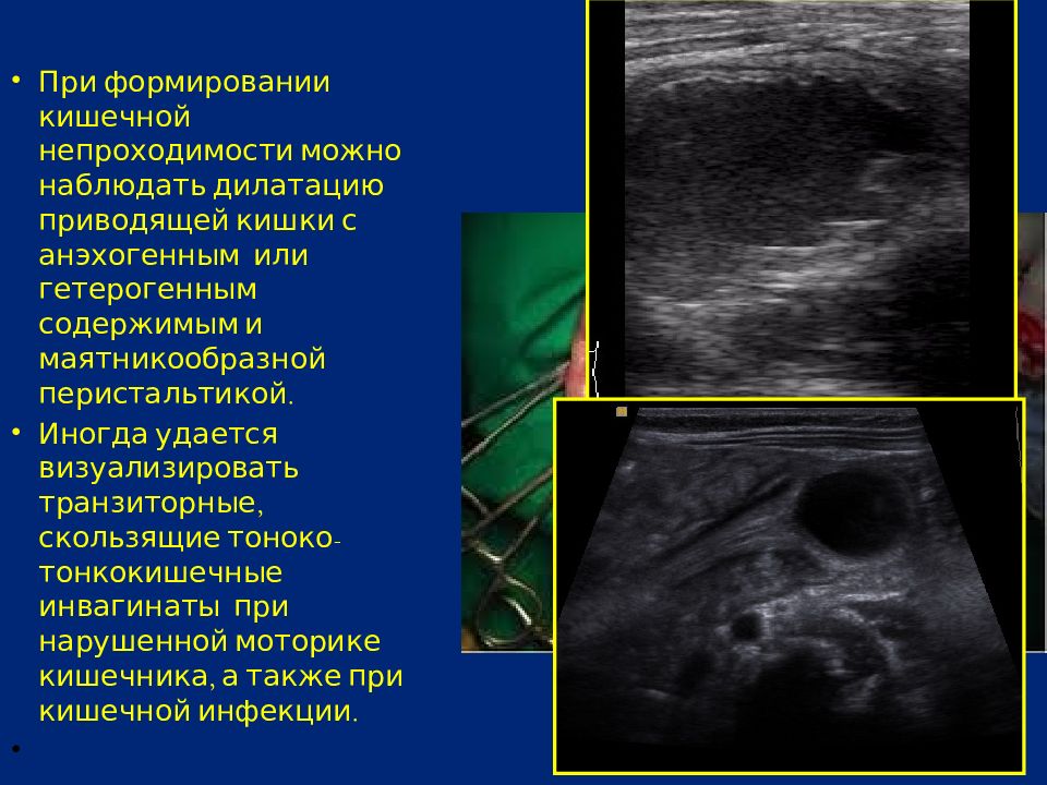 Анэхогенное аваскулярное образование в паренхиме. Анэхогенный участок отслойки.