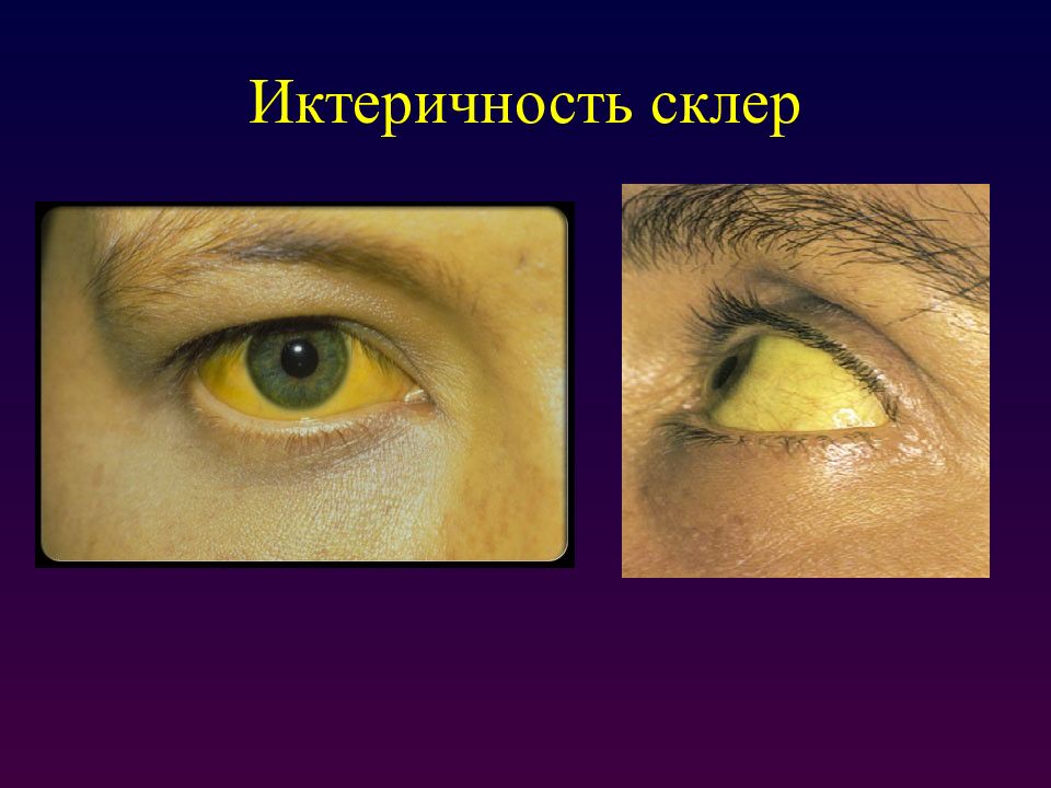 Вирусный гепатит желтушный период. Симптомы гепатита желтухи. Субиктеричность склер. Желтушность склер глаз. Желтушность склер при гепатите.