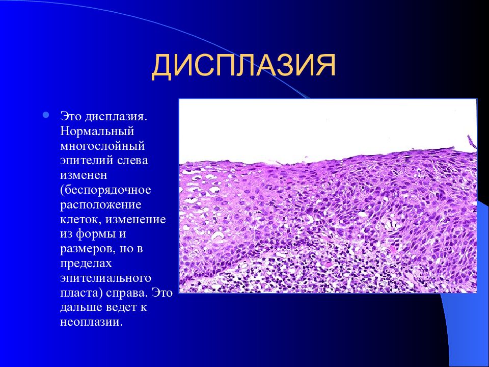 Метаплазия эндометрия. Дисплазия метаплазия патанатомия.