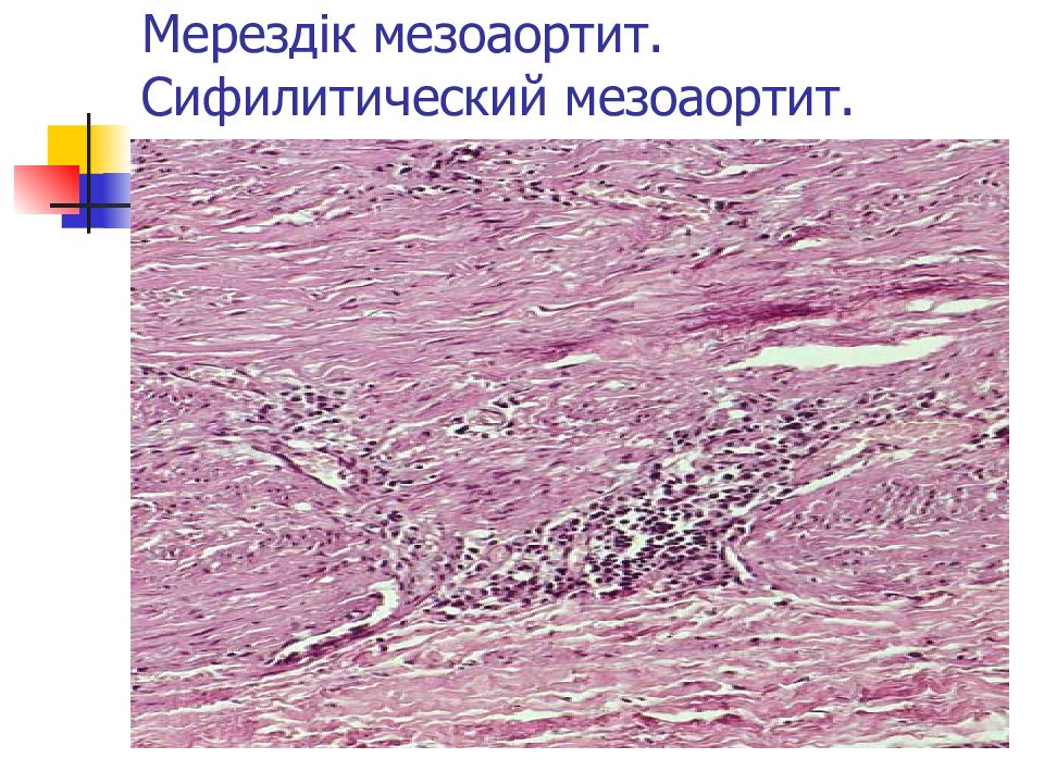 Сифилитический аортит презентация