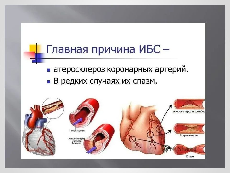 Презентация ишемия сердца