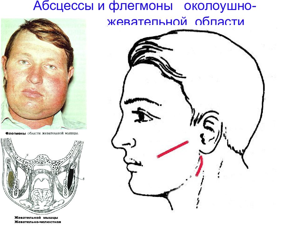 Абсцесс и флегмона. Абсцесса флегмоны височной области клиника. Флегмона околоушно-жевательной области. Околочелюстная флегмона. Абсцессы и флегмоны околоушно-жевательной области операция.