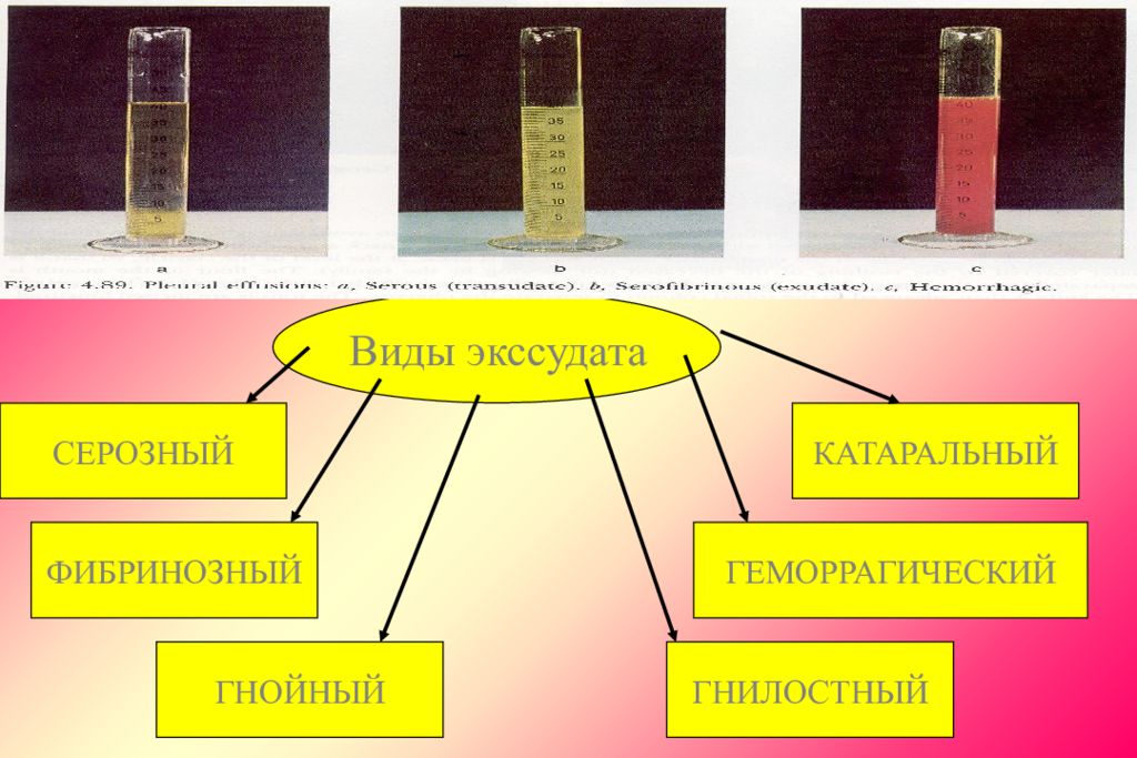 Состав гнойного экссудата