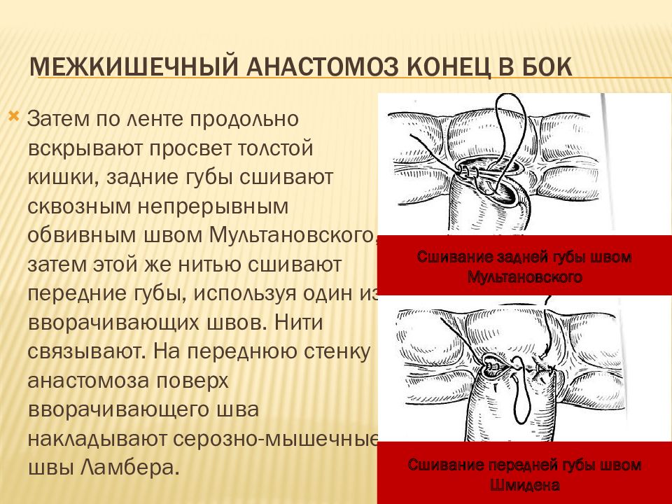 Анастомоз конец в конец схема