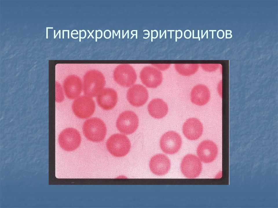 Макроциты. Гиперхромная анемия. Гипохромия и гиперхромия. Гиперхромная макроцитарная анемия микроскоп. Гиперхромия без анемии.