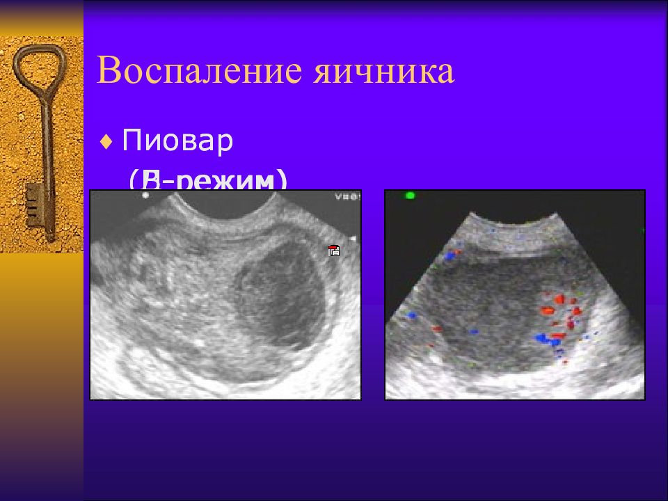 Кисты яичников презентация гинекология