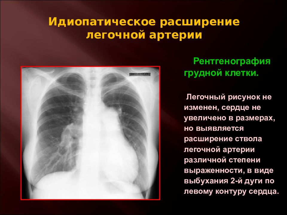 Расширение левой. Расширение ствола легочной артерии на рентгене. Расширение легочной артерии рентген. Аневризма легочной артерии рентген. Признаки расширение легочной артерии рентген.