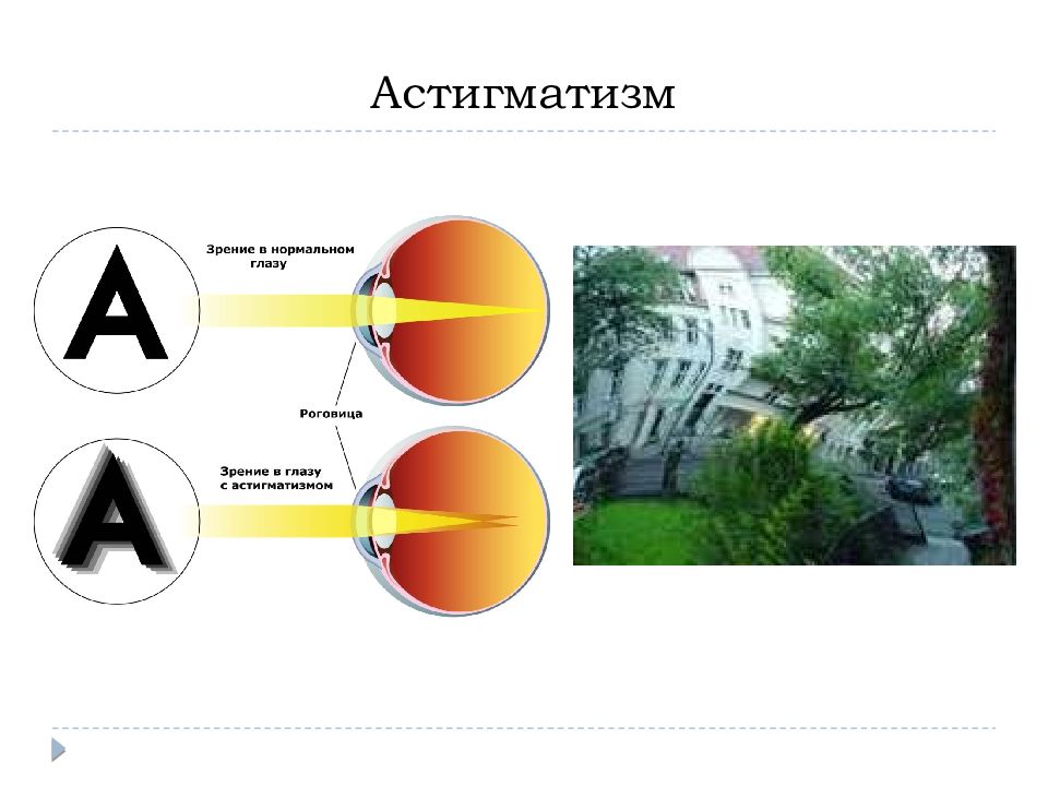 Астигматизм это. Астигматизм. Астигматизм и нормальное зрение. Легкий астигматизм. Зрение при астигматизме.