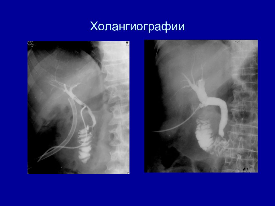 Холангиография. Холангиография рентген норма. Холангиография контрастное вещество. Фистульная холангиография. Фистулография желчных протоков.