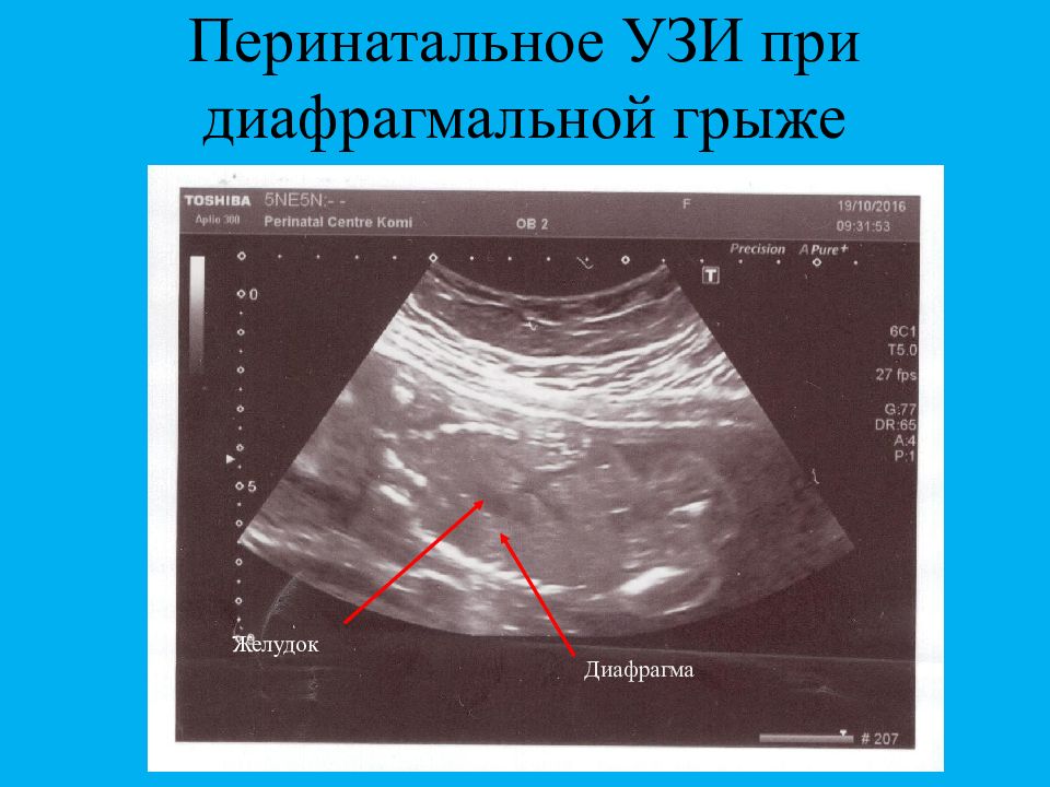 Диафрагмальная грыжа презентация хирургия