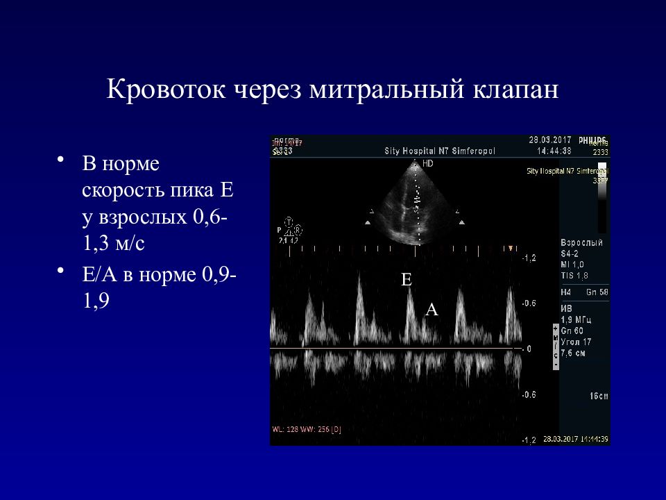 Эхо норма. Митральный клапан ЭХОКГ. Нормальный митральный клапан на ЭХОКГ. ЭХОКГ скорости на клапанах. Эхокардиография митральный клапан скорость.