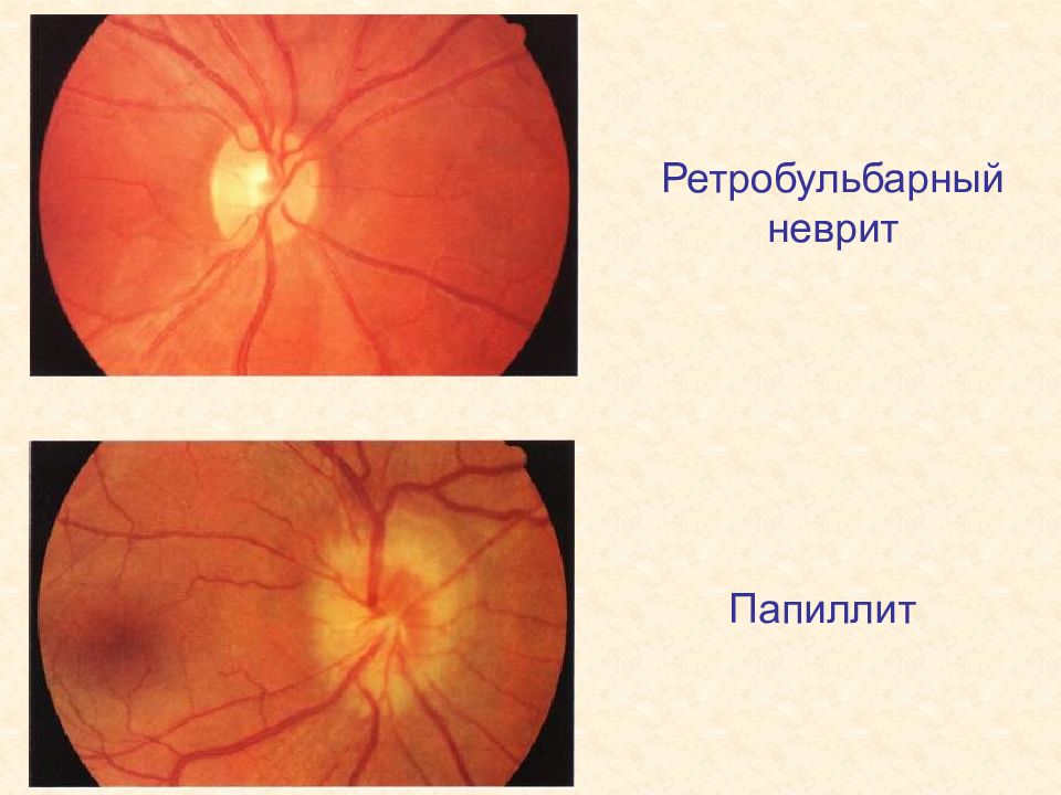 Заболевания сетчатки и зрительного нерва офтальмология презентация