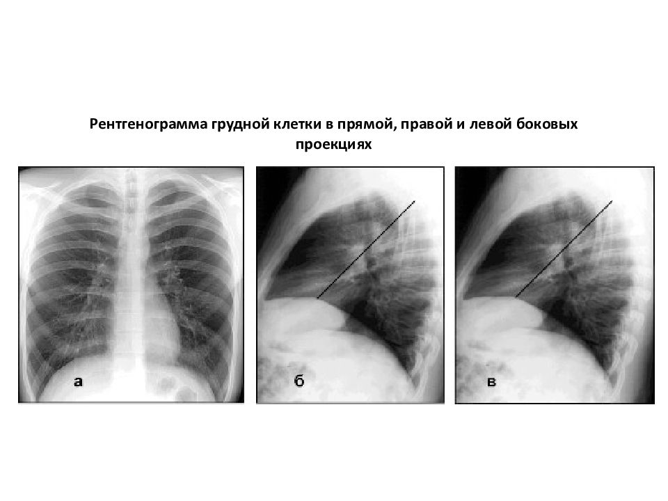 Рентген в 2 проекциях. Рентгенография органов грудной клетки в 3-х проекциях. Рентген грудной клетки в 2-х проекциях. Рентген грудной клетки в 3 проекциях. Рентгенография грудной клетки в прямой проекции.