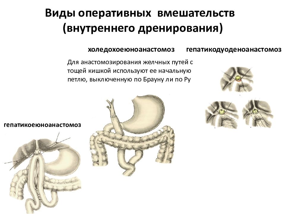 Анастомоз по ру схема