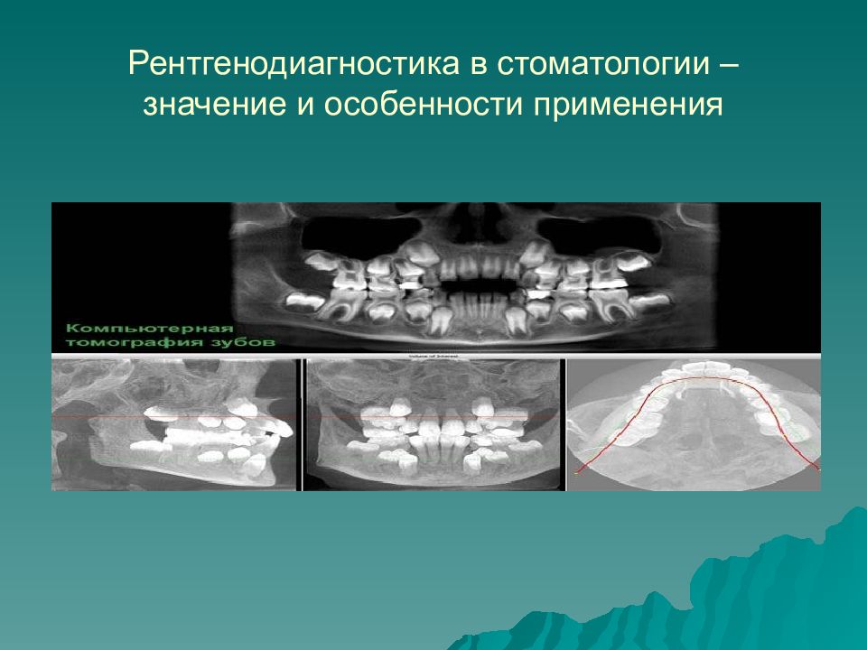 Рентгенодиагностика в стоматологии презентация