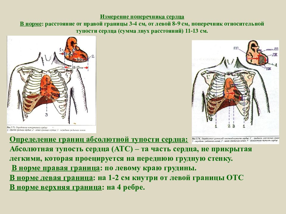 Сердечная тупость. Границы абсолютной тупости сердца в норме. Границы относительной тупости сердца поперечник. Измерение поперечника сердца. Границы относительной тупости сердца в норме.