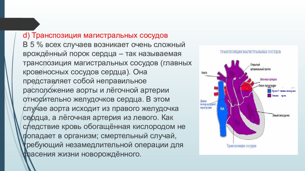 Транспозиция артерий