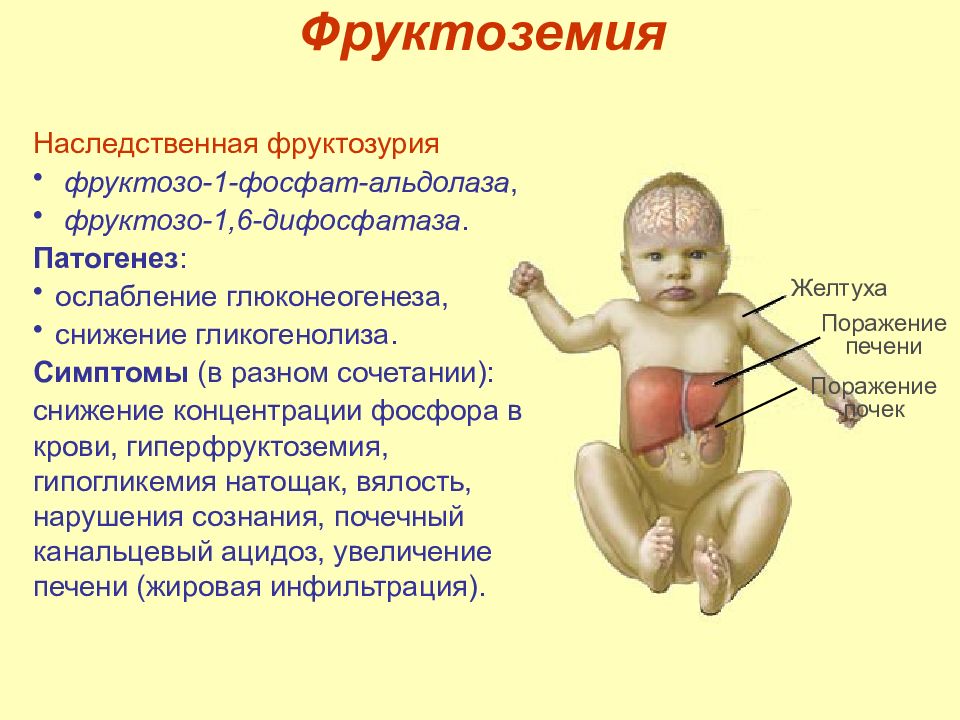 Мальабсорбция глюкозы. Фруктозурия симптомы. Фруктозурия патогенез. Фруктоземия патогенез. Галактоземия и фруктоземия биохимия.