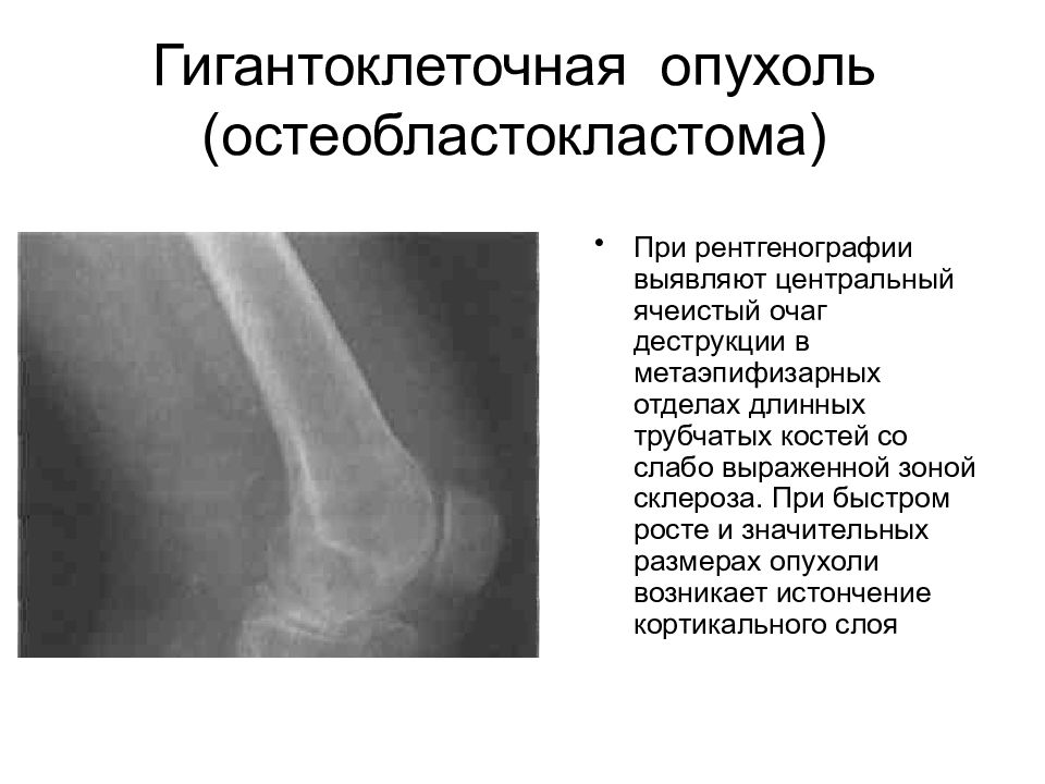 Опухоли костей схема