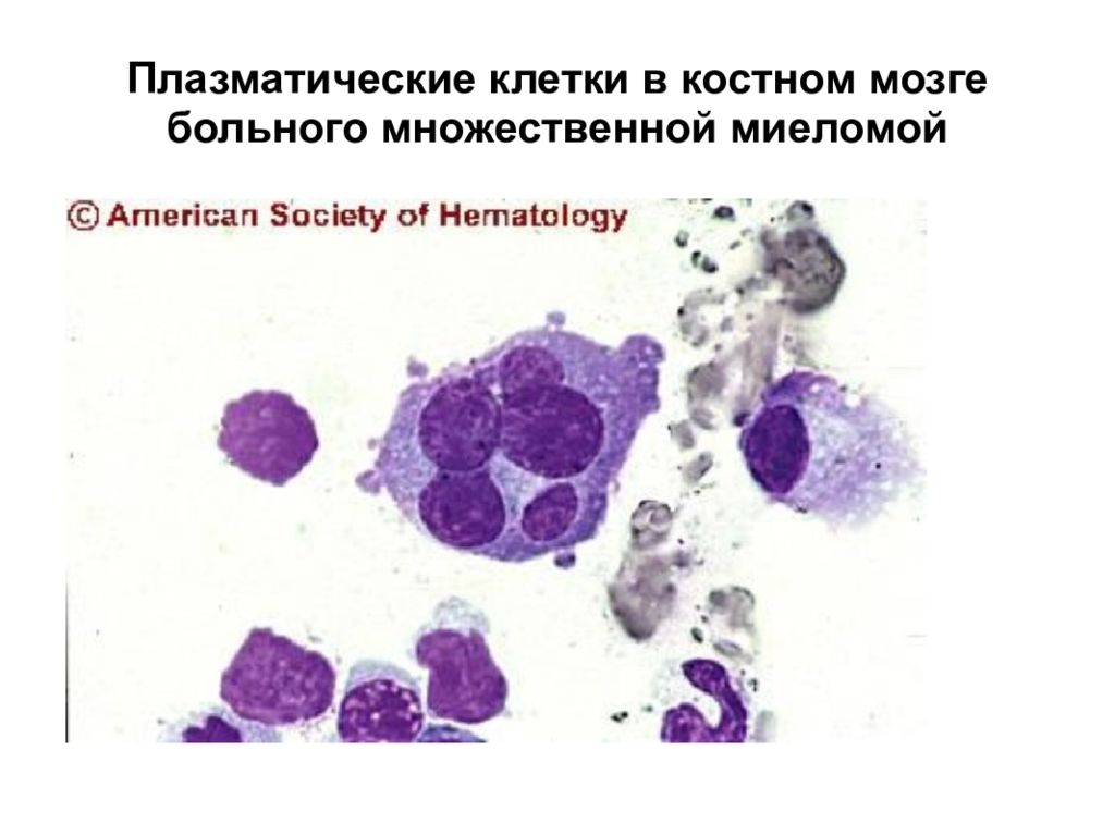 Миелома джонса. Миеломная болезнь плазматические клетки. Плазмоцит гистология. Плазматическая клетка мазок крови. Миеломная нефропатия гистология.